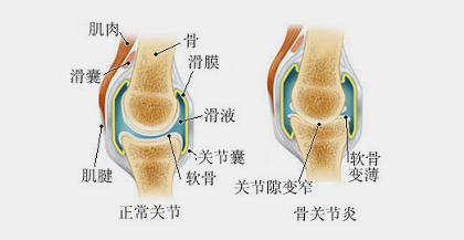 关节炎