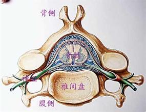腰椎间盘突出