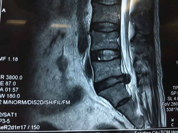 患者腰椎核磁共振片