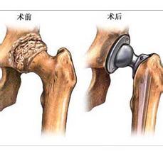 关节置换术前术后