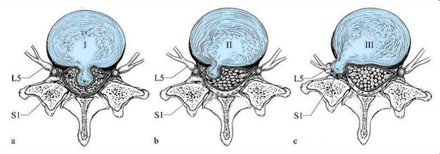 腰椎滑脱的分期