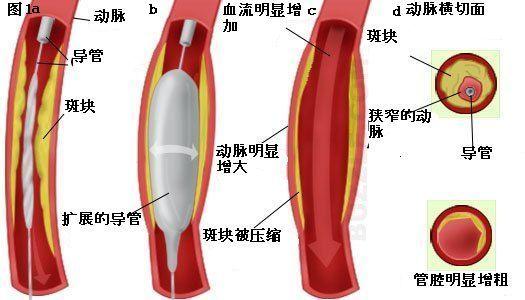 冠心病