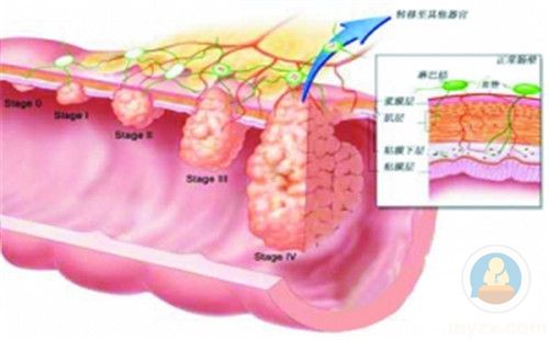 直肠癌分期图