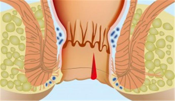 肛裂图