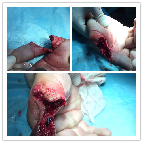 铜陵博爱医院患者右拇指切割伤离断