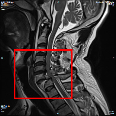 多组核磁图显示颈椎骨折