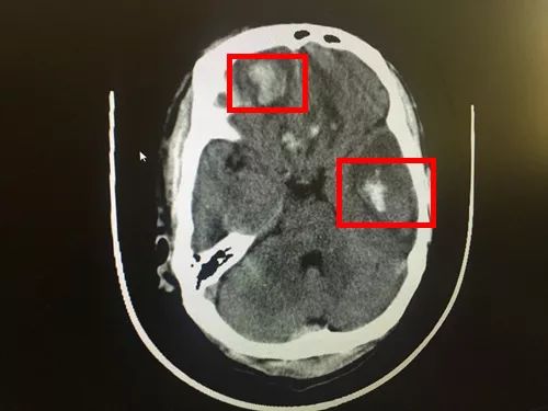 红框处是患者脑部血肿的位置