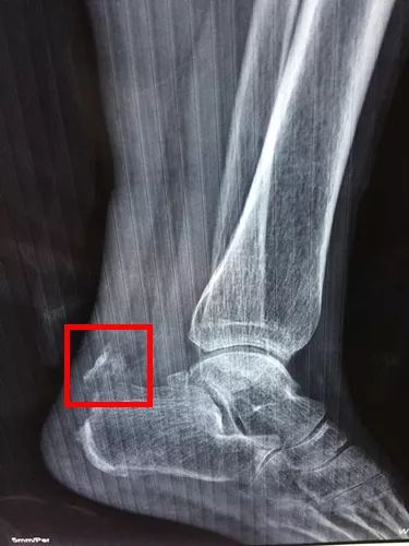 X片显示患者骨折部位