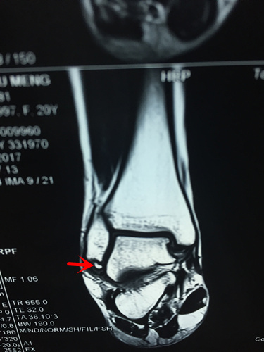 核磁可见腓骨远端陈旧性撕脱性骨折